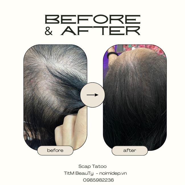 trước và sau khi căm vùng trắng da đầu cho một trường hợp tóc nữ