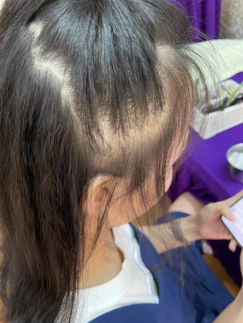tình trạng tóc nữ thưa trẳng vùng đỉnh đầu và cả đầu