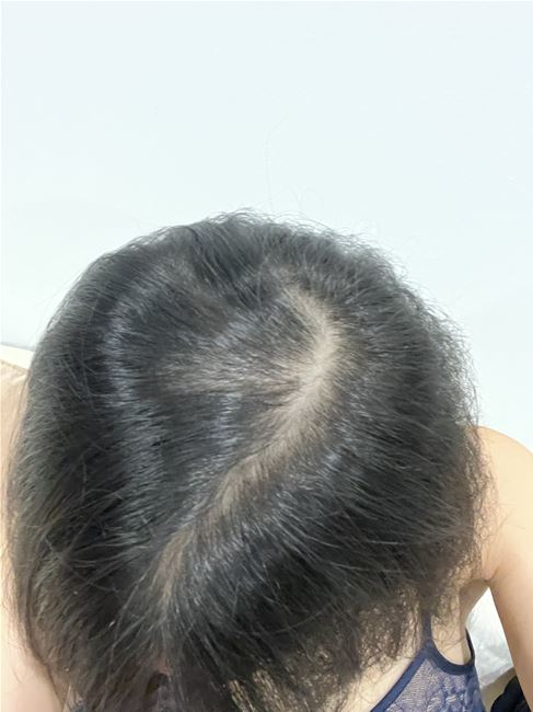 tình trạng tóc nữ thưa trẳng vùng đỉnh đầu và cả đầu