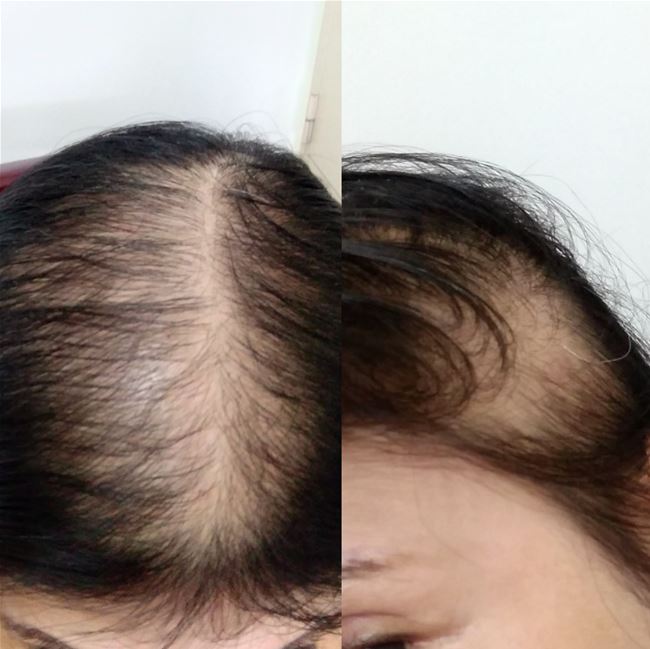 tình trạng tóc nữ thưa trẳng vùng đỉnh đầu và cả đầu