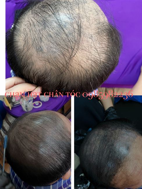 xăm chân tóc khắc phục hói kết hợp hói chữ o và hói chữ u