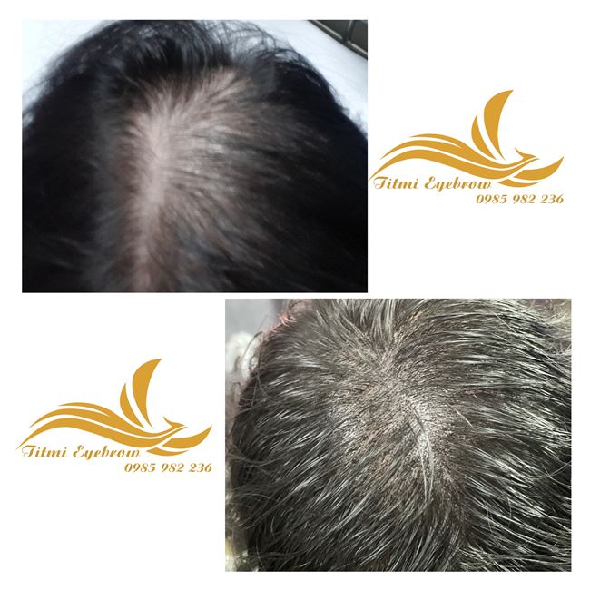 hiệu ứng điêu khắc chân tóc cho người bị trắng da đầu