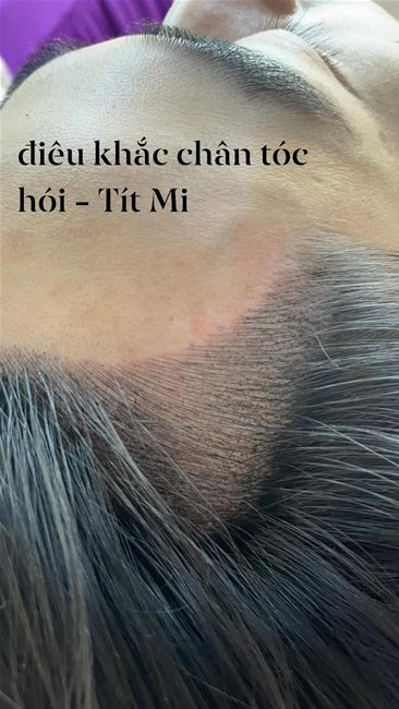 điêu khắc vùng hói bò liếm chữ M