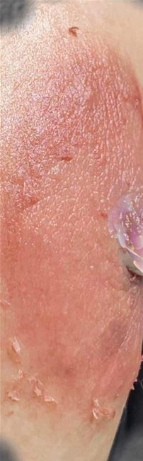 nhũ hoa đang bong, màu rất tự nhiên nhũ hoa đang bong, màu rất tự nhiên