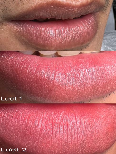 hình ảnh màu môi sau khi khử thâm, màu trong mỏng, rất ít tổn thương