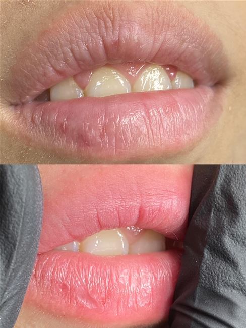 hình ảnh màu môi sau khi khử thâm, màu trong mỏng, rất ít tổn thương