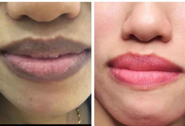 khử thâm môi cho nữ và nam khác biệt hòa toàn khử thâm môi cho nữ và nam khác biệt hòa toàn