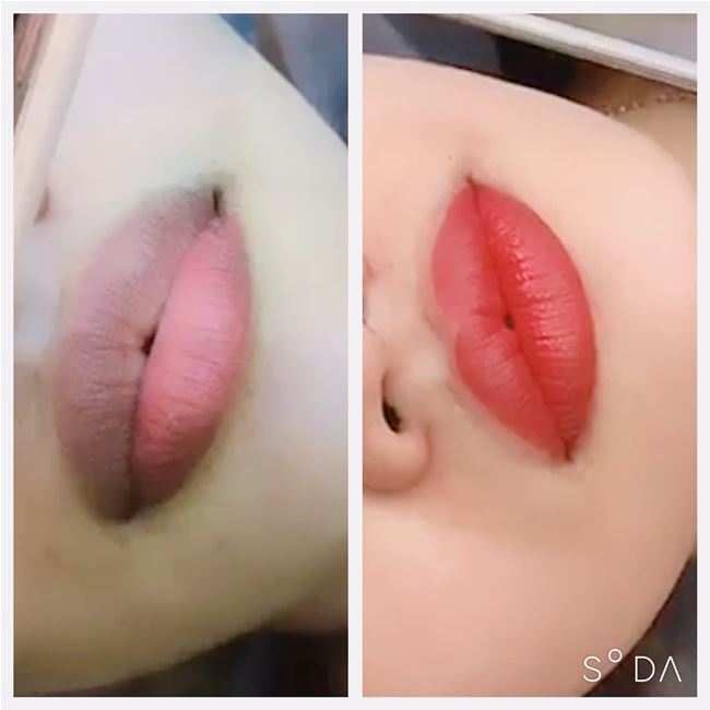 combo phun khử thâm môi và thu nhỏ môi trên