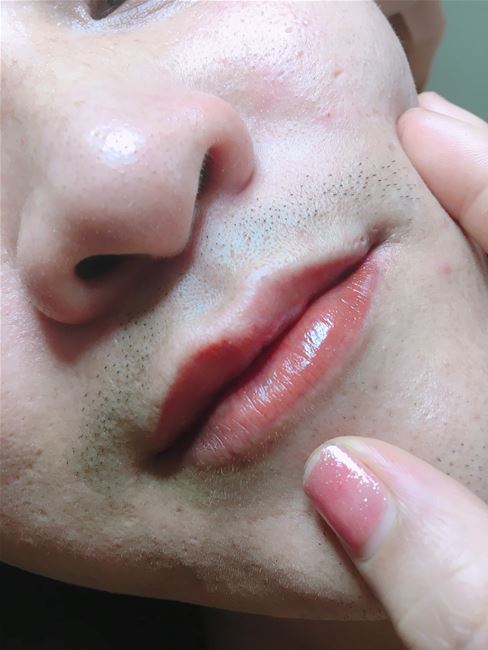 phun khủ thâm môi nam