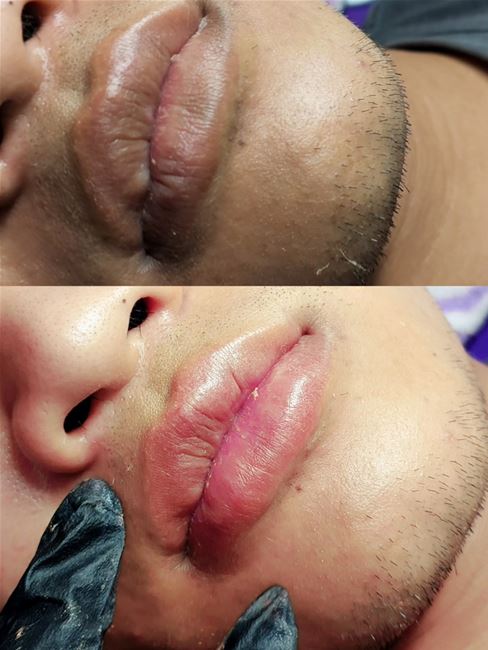 Môi nam khử thâm và vào màu nhẹ nhàng tự nhiên