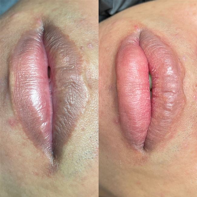 Môi nam khử thâm và vào màu nhẹ nhàng tự nhiên