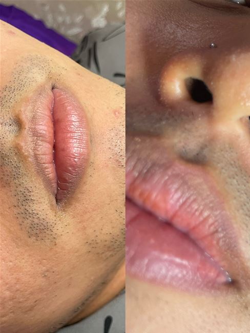 phun khủ thâm môi nam