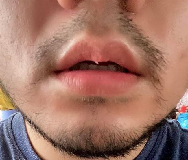 phun khủ thâm môi nam