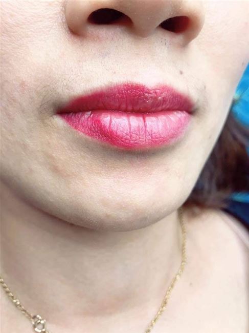 môi tết bào gốc đã bong