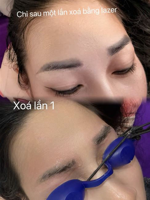 xóa chân mày maù xanh