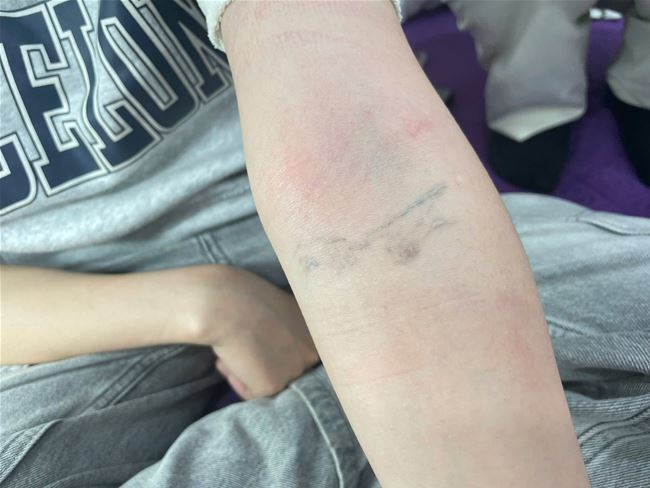 xóa xăm tatoo hình xăm trên cánh tay