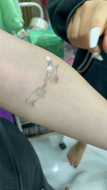 xóa xăm tatoo hình xăm trên cánh tay