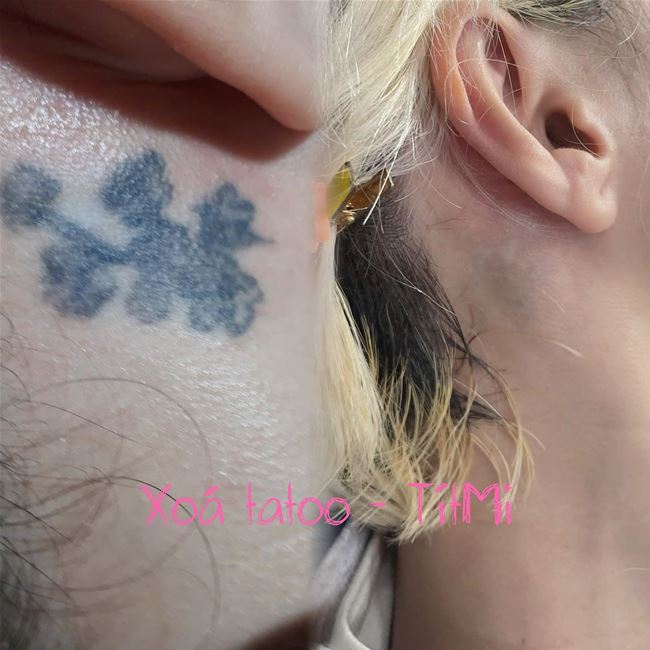 xóa xăm tatoo hết 98%