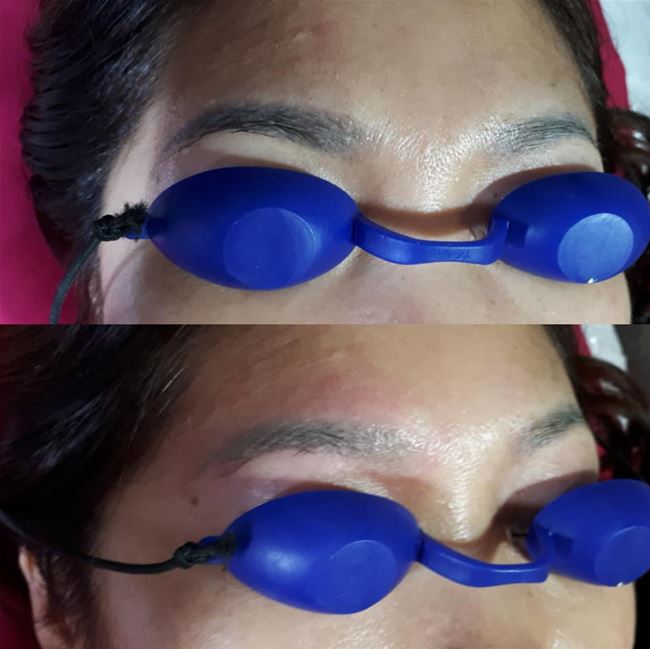 XÓA TRỔ XANH TRONG VÒNG 1 LẦN XÓA