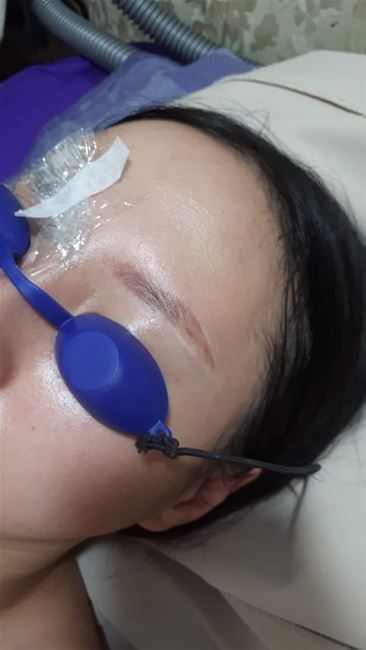 chân mày trổ đỏ của khách trước khi xóa tại Tít Mi