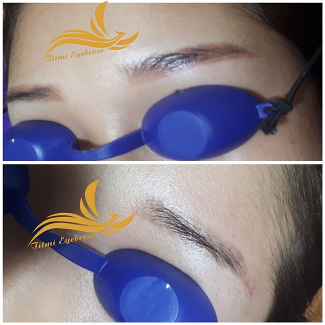 xóa chân mày trổ đỏ tại Tít Mi