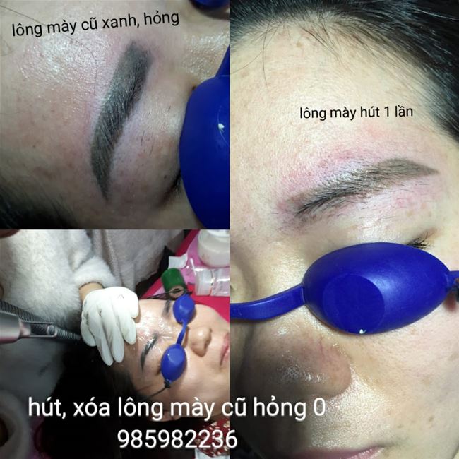 xóa chân mày cũ xanh bên to bên nhỏ xóa chân mày cũ xanh bên to bên nhỏ