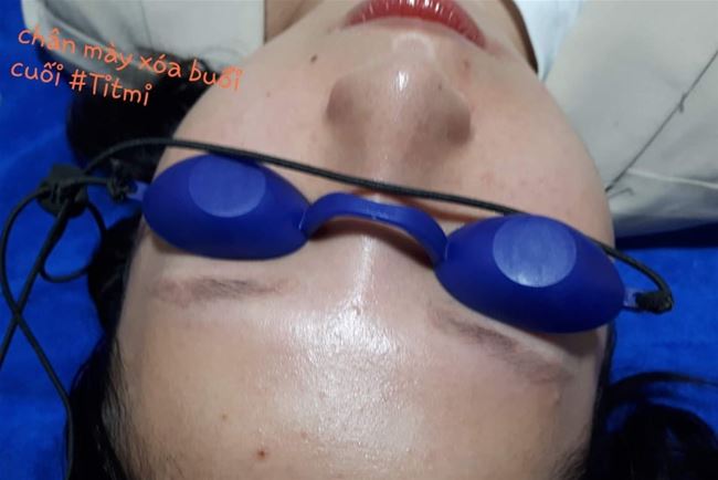 chân mày trổ đỏ của khách sau khi xóa  hết liệu trình tại Tít Mi